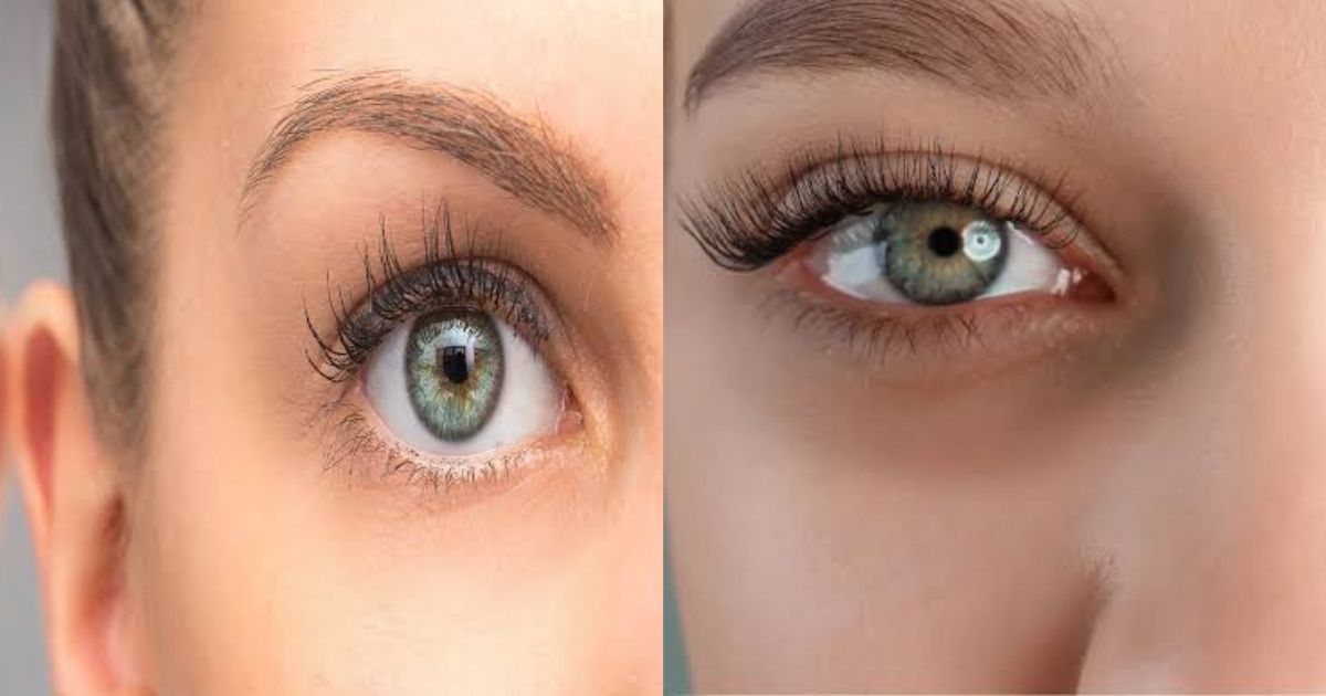 Can Sunken Eyes Be Reversed